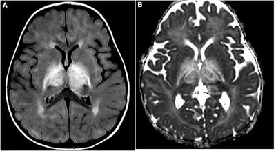 Can early-onset acquired demyelinating syndrome (ADS) hide pediatric Behcet's disease? A case report